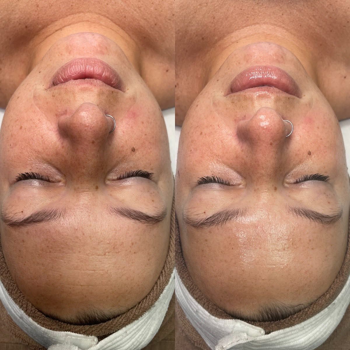 Facial before and after
