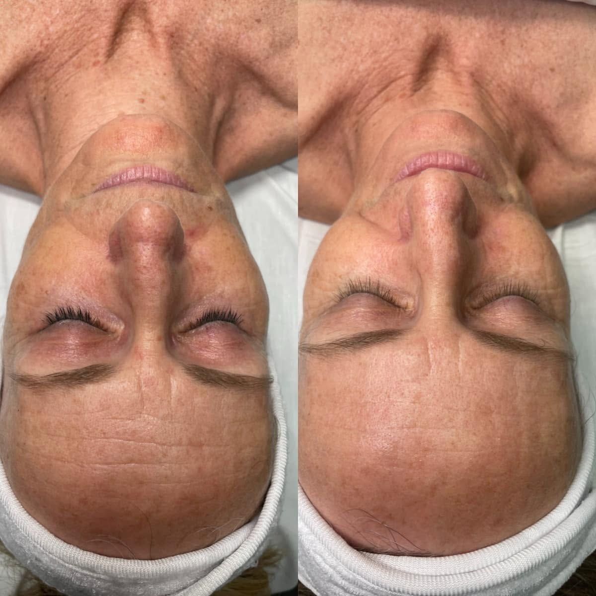 Forehead texture before and after