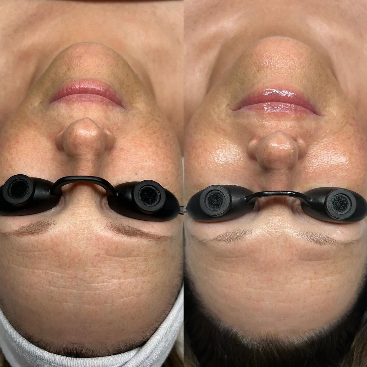 Skin clarity before and after
