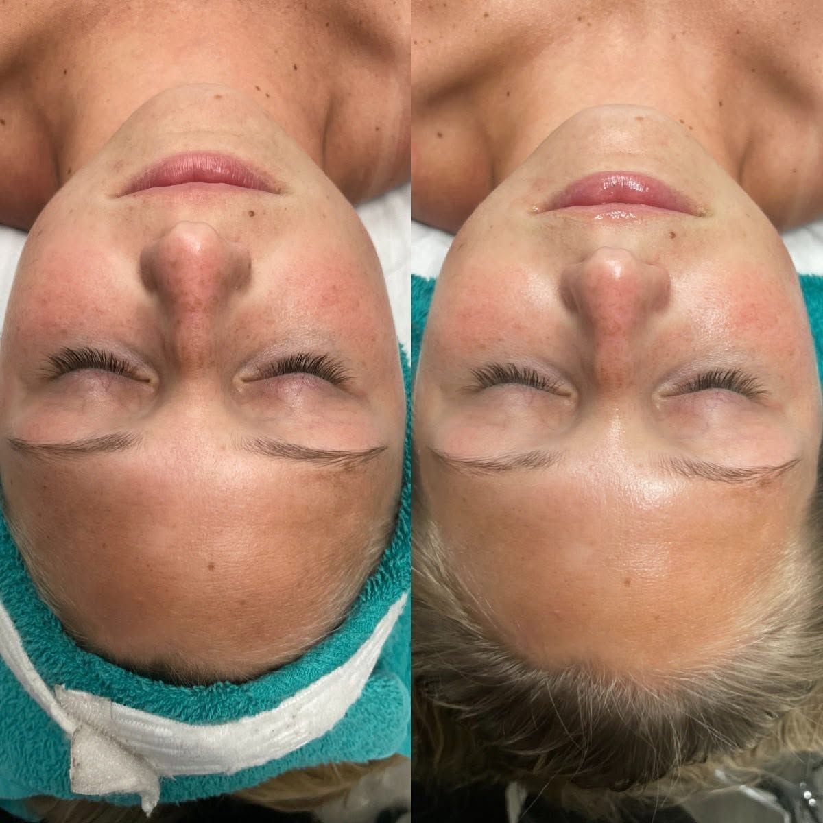 Complexion before and after