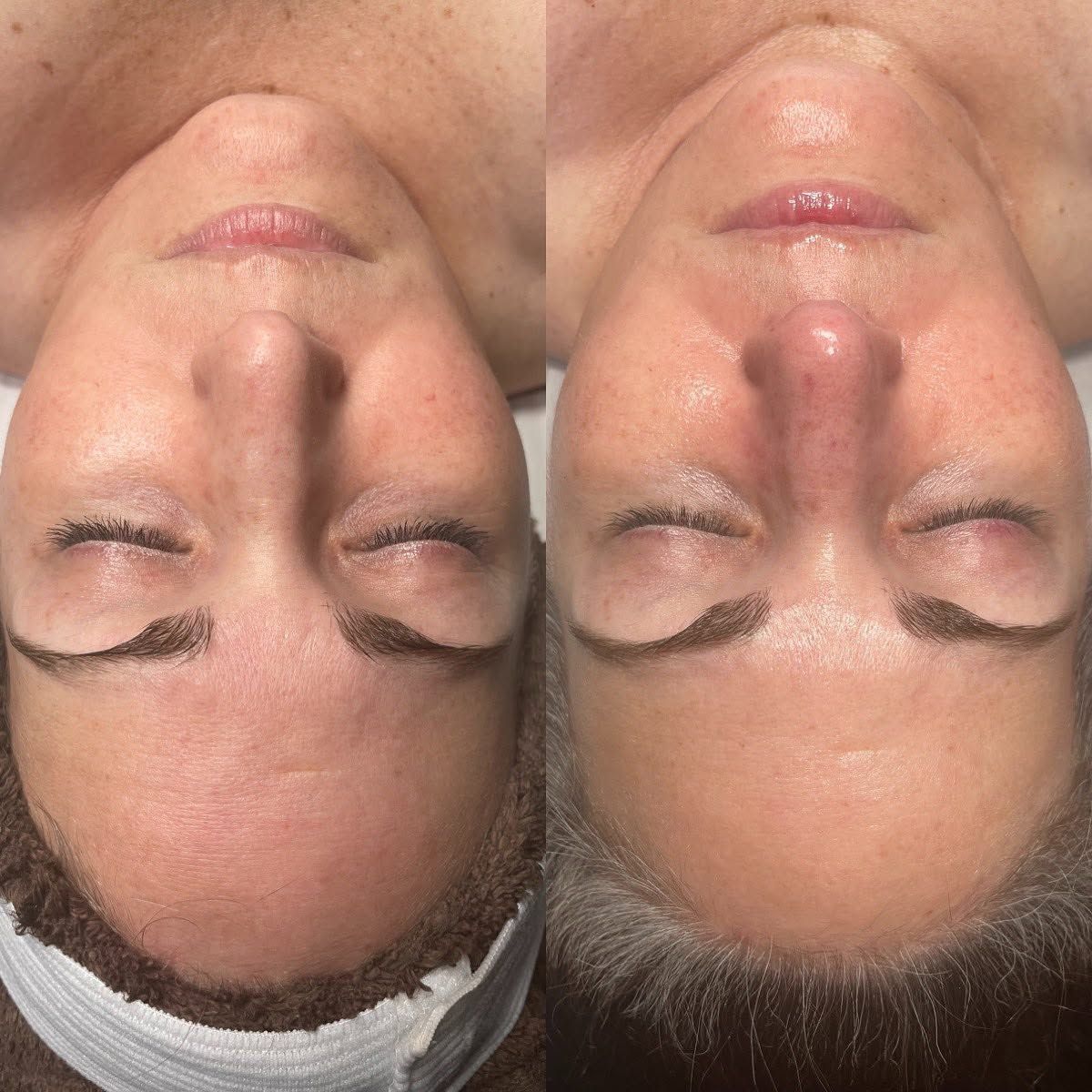Facial treatment before and after